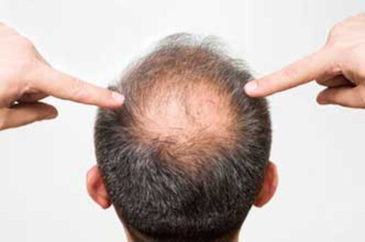 Alopecia androgenética: en que consiste